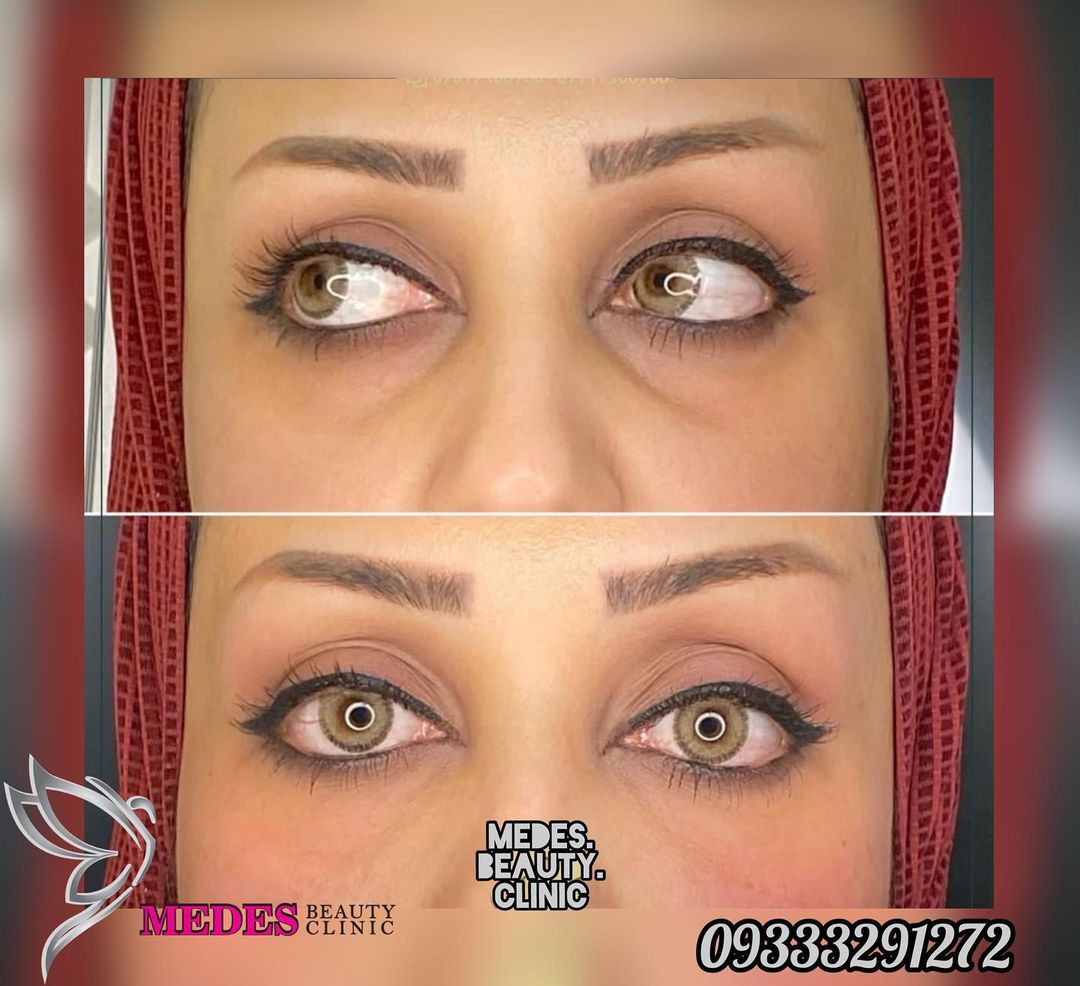 گالری فیلر زیر چشم